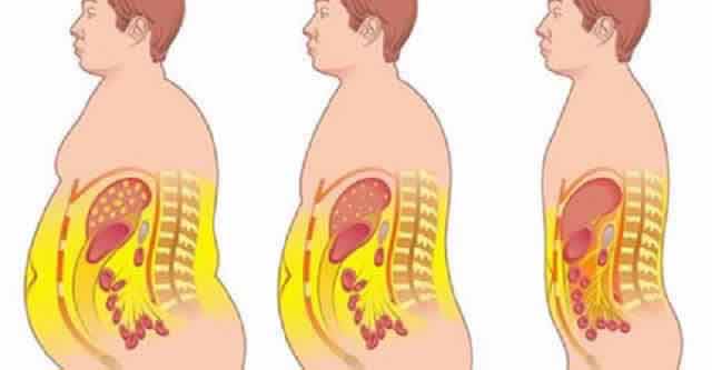 Comment obtenir un ventre plat grâce à l'abdominoplastie?